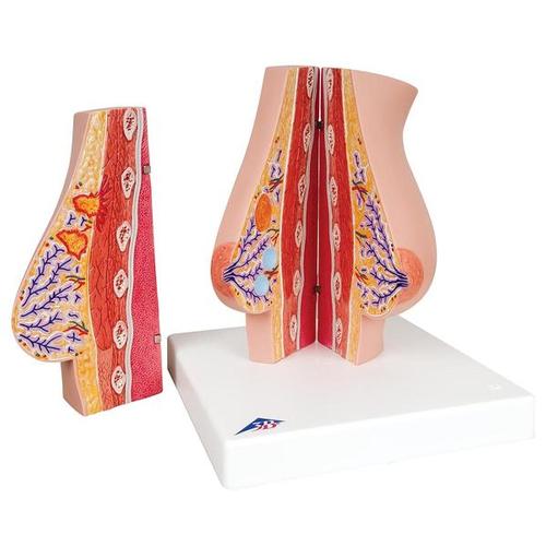 Model of Female Breast with Healthy & Unhealthy Tissue - 3B Smart Anatomy, 1008497 [L56], Breast Models