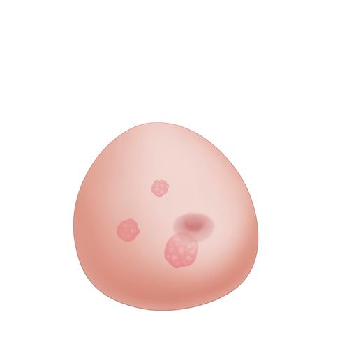 낭종이 있는 유방모형 SONOtrain Breast model with tumours, 1019635 [P125], 초음파 기술 트레이너