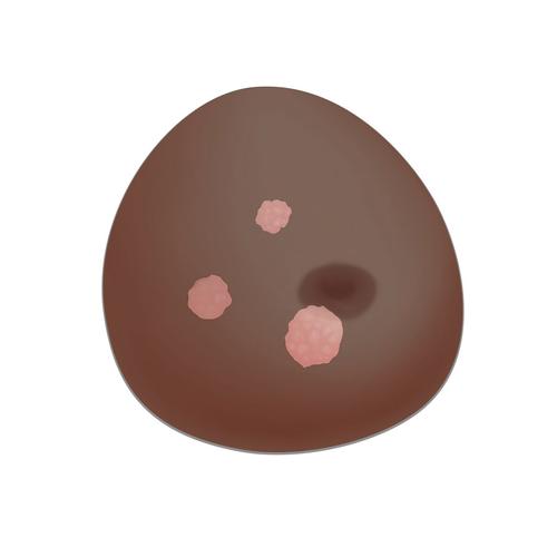 SONOtrain Breast model with tumours, Dark Skin, 1024723 [P125D], Ultrasound Skill Trainers