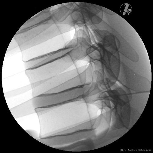 Treinador de inje&ccedil;&atilde;o espinhal tor&aacute;cica guiada por imagem P66, 1021899 [P66], Inje&ccedil;&otilde;es e Pun&ccedil;&atilde;o