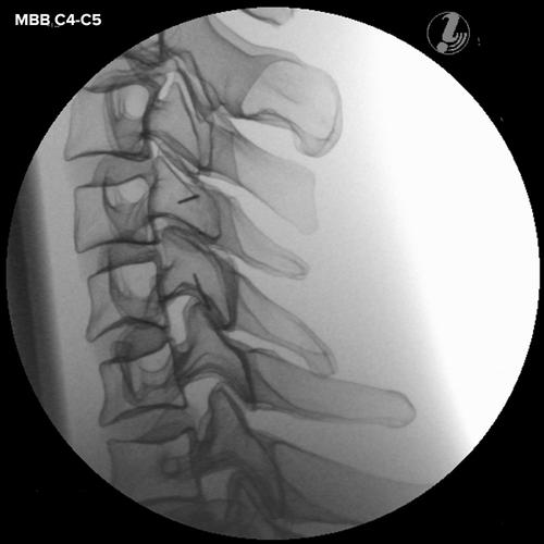 Simulador P67 de inje&ccedil;&atilde;o na coluna cervical guiada por imagem
, 1021900 [P67], Inje&ccedil;&otilde;es e Pun&ccedil;&atilde;o