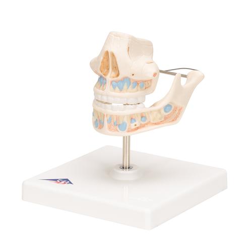 Milk Denture Model with Remaining Teeth - 3B Smart Anatomy, 1001248 [VE282], Dental Models