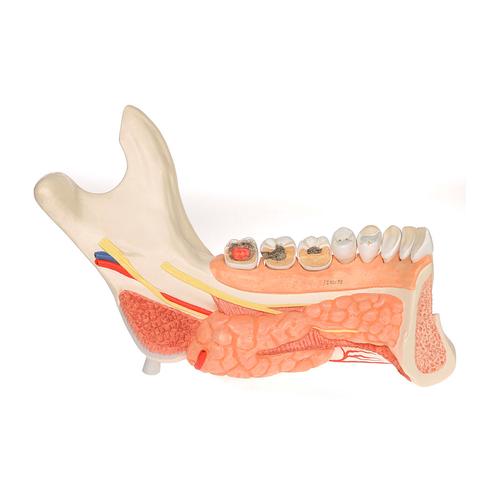 Mitad de la mandíbula inferior con 8 dientes cariados, 19 piezas - 3B Smart Anatomy, 1001250 [VE290], Modelos dentales