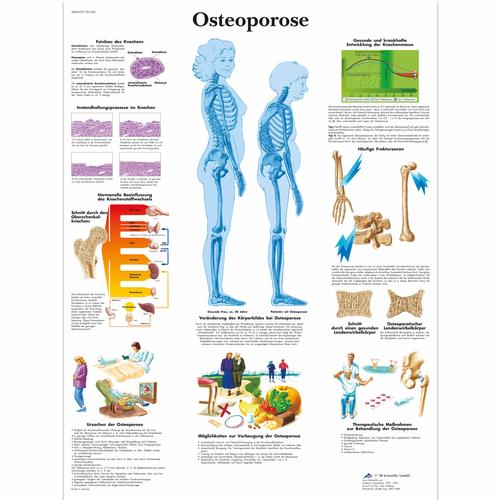 Osteoporose Chart, 1001306 [VR0121L], Arthritis and Osteoporosis Education