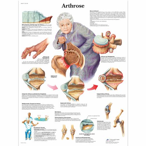 Lehrtafel - Arthrose, 4006571 [VR0123UU], Arthritis und Osteoporose