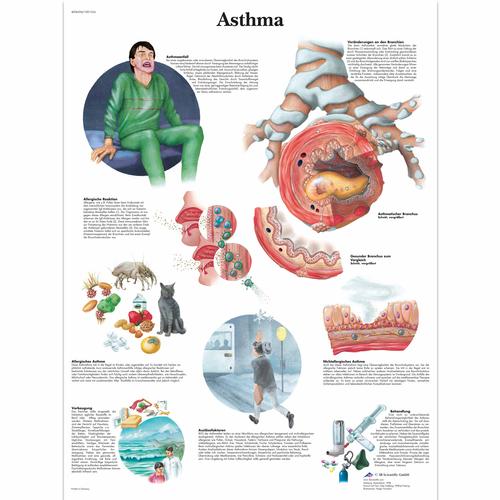 Asthma Chart, 1001354 [VR0328L], Asthma and Allergies Education