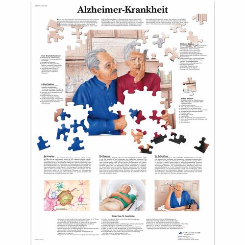 Alzheimer-Krankheit, 1001428 [VR0628L], Cervello e del sistema nervoso