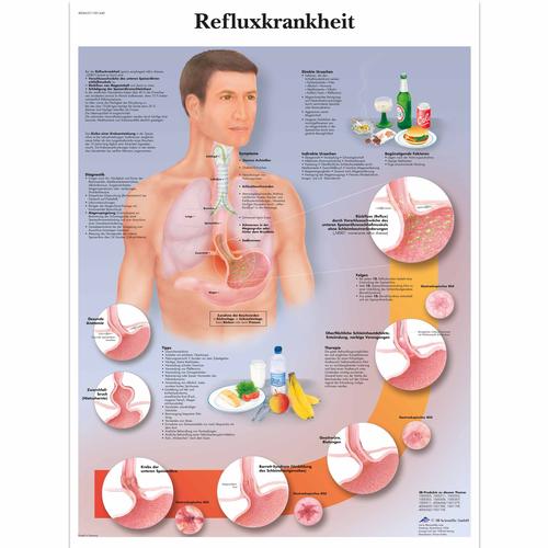 Refluxkrankheit, 1001440 [VR0711L], Il sistema digestivo

