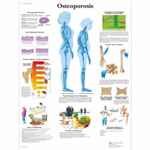 Pôster da Osteoporose, 1001472 [VR1121L], Sistema Esqueletico