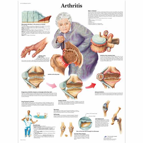 Arthritis Chart, 1001474 [VR1123L], Strumenti didattici su artrite e osteoporosi