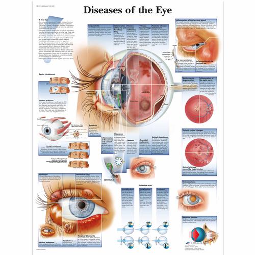 眼部疾病解剖挂图, 1001498 [VR1231L], 眼睛