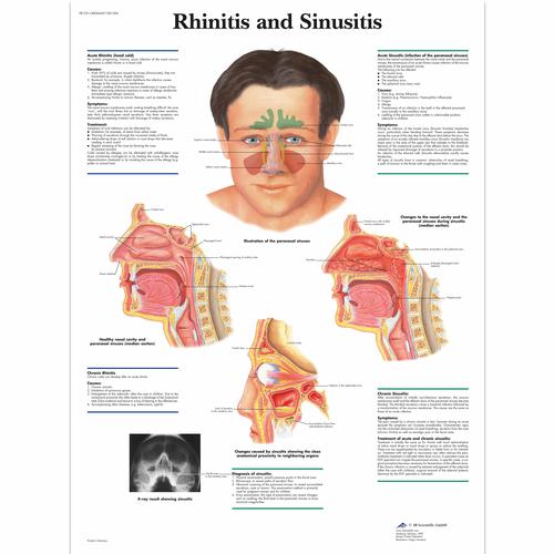 Rhinitis and Sinusitis Chart, 1001504 [VR1251L], Ear, Nose and Throat (ENT)