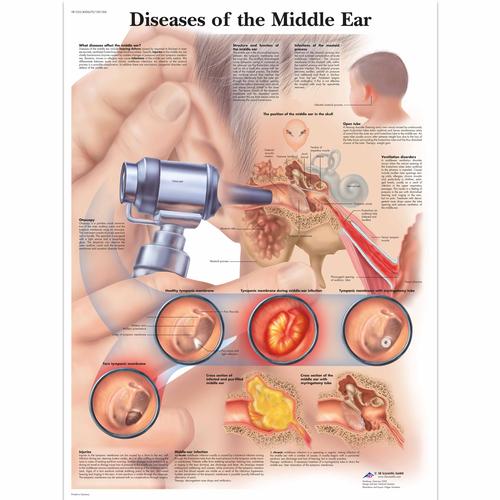 中耳疾病解剖挂图, 1001506 [VR1252L], 耳，鼻，喉