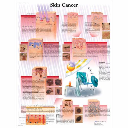 Skin Cancer Chart, 1001514 [VR1295L], Cancers