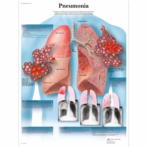 Lehrtafel - Pneumonia, 1001518 [VR1326L], Parasit&auml;re, virale oder bakterielle Infektion