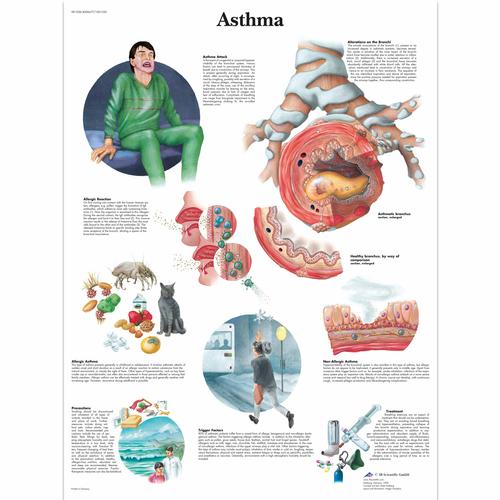 Asthma Chart, 1001520 [VR1328L], Respiratory System