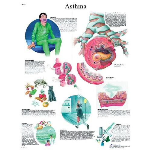 Asthma STICKYchart™, VR1328S, Respiratory System