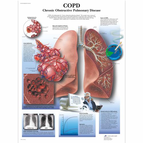 COPD Chart - Chronic Obstructive Pulmonary Disease, 4006678 [VR1329UU], Respiratory System
