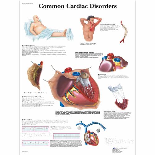 Pôster dos Distúrbios Cardíacos Comuns, 1001526 [VR1343L], Sistema Cardiovascular