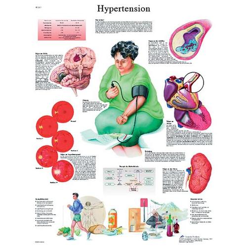 Hypertension STICKYchart™, VR1361S, Cardiovascular System