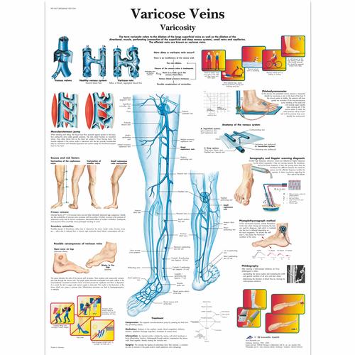 Varicose Veins Chart, 4006684 [VR1367UU], Cardiovascular System