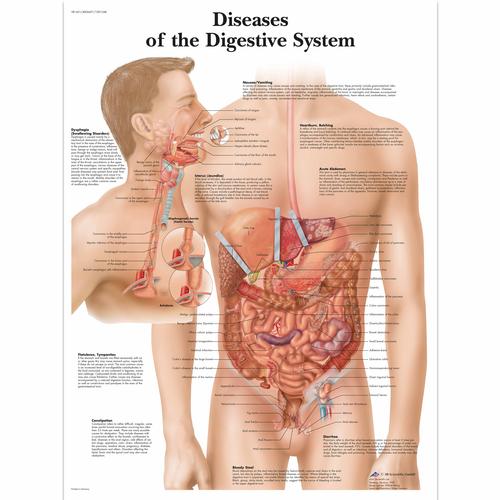 Diseases of the Digestive System Chart, 4006691 [VR1431UU], Digestive System