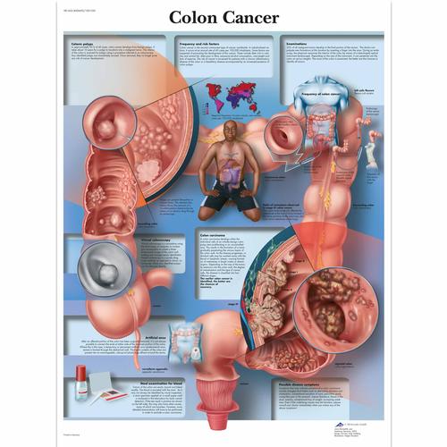 Colon Cancer Chart, 4006692 [VR1432UU], Cancers