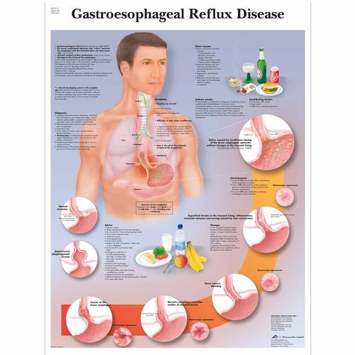Gastroesophageal Reflux Disease Chart (GERD), 1001602 [VR1711L], Digestive System