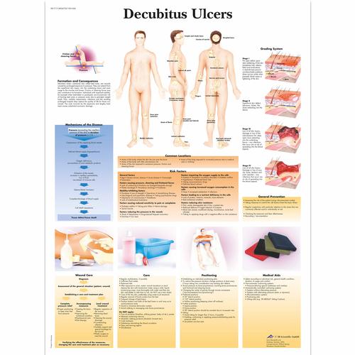 Decubitus Ulcers Chart, 1001606 [VR1717L], Skin