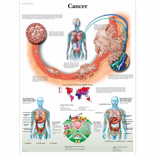 Cancer, 1001612 [VR1753L], Los tipos de cáncer