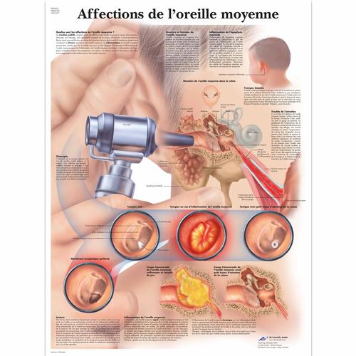 Lehrtafel - Affections de l'oreille moyenne, 4006753 [VR2252UU], Hals, Nasen und Ohren (HNO)