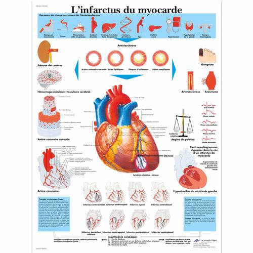 L'infarctus du myocarde, 1001692 [VR2342L], 心脏健康和身体健康教育示意图