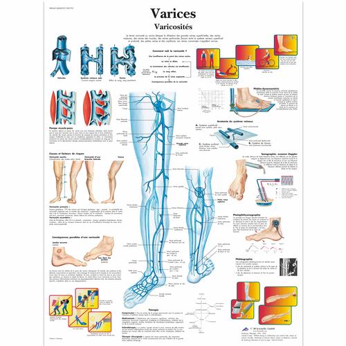 Varices, varicosités, 4006767 [VR2367UU], système cardiovasculaire