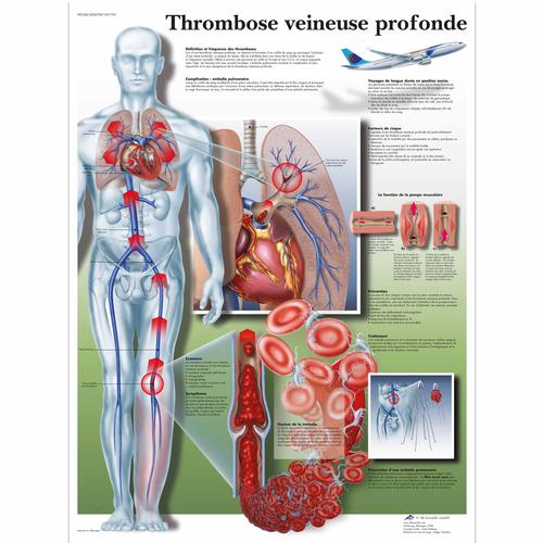 Lehrtafel - Thrombose veineuse profonde, 1001703 [VR2368L], Herz-Kreislauf-System
