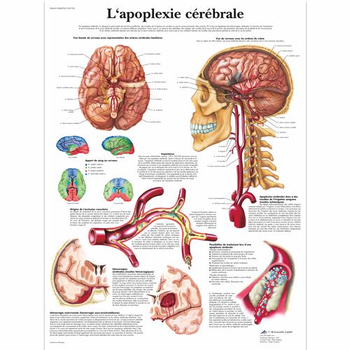 L'apoplexie cérébrale, 1001758 [VR2627L], 心血管系统