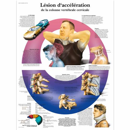 Lésion d’acceleration de la colonne vertébrale cervicale, 1001783 [VR2761L], 骨骼系统