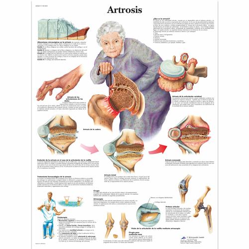 Artrosis, 4006817 [VR3123UU], Skeletal System
