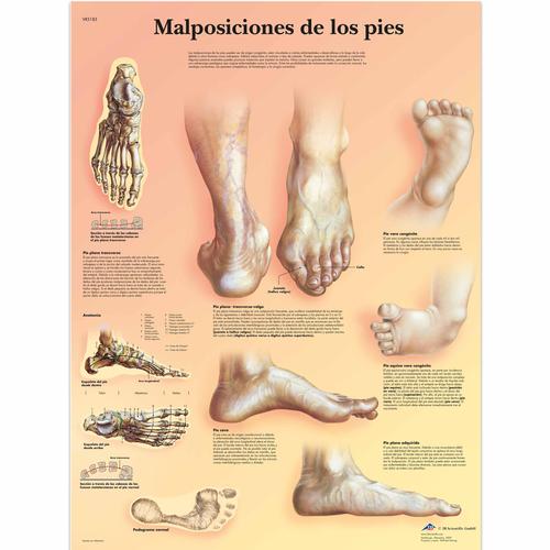 Malposiciones de los pies, 1001823 [VR3185L], 骨骼系统