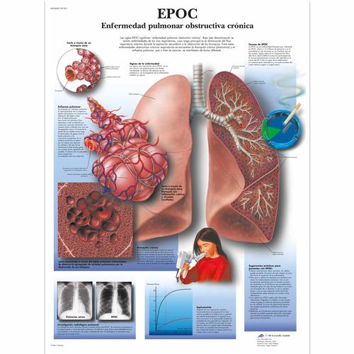 EPOC Enfermedad pulmonar obstructiva crónica, 4006840 [VR3329UU], Sistema Respiratorio