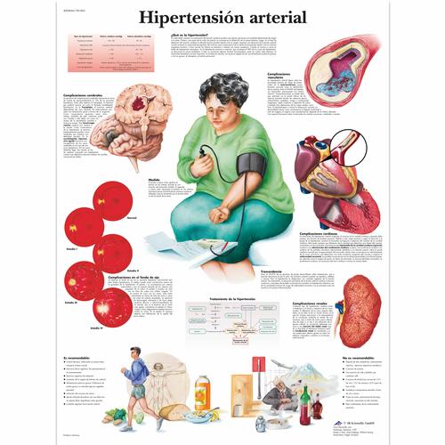 Lehrtafel - Hipertensión arterial, 1001863 [VR3361L], Herz-Kreislauf-System