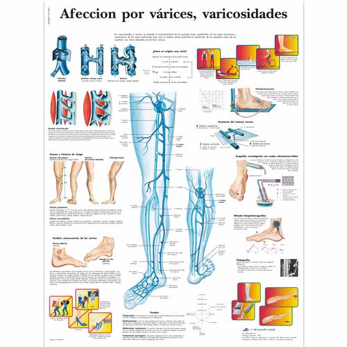 Afección por várices, Varicosidades, 4006847 [VR3367UU], 心血管系统