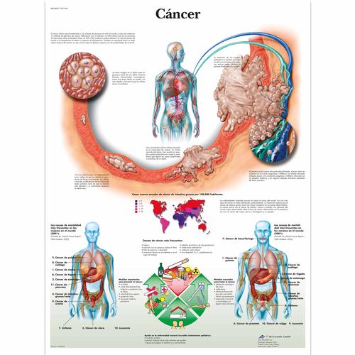 Cáncer, 1001945 [VR3753L], Los tipos de cáncer