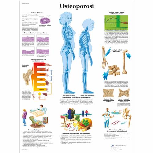 Osteoporosi, 1001967 [VR4121L], 关节炎和骨质疏松症示意图