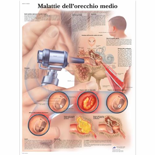 Lehrtafel - Malattie dell&rsquo;orecchio medio, 4006917 [VR4252UU], Hals, Nasen und Ohren (HNO)