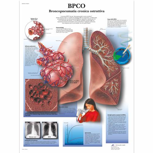 Lehrtafel - BPCO Broncopneumopatia cronia ostruttiva, 1002021 [VR4329L], Gefahren des Rauchens