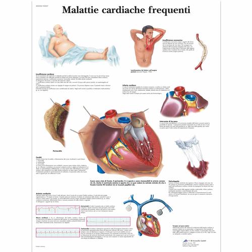 Malattie cardiache frequenti, 1002027 [VR4343L], 心脏健康和身体健康教育示意图