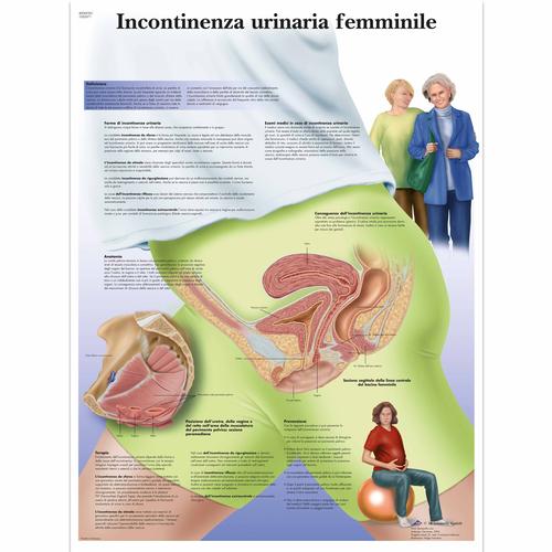 Incontinenza urinaria femminile, 1002071 [VR4542L], Ginecologia
