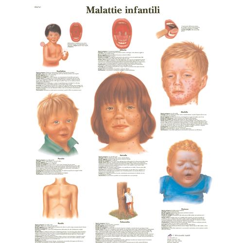 Lehrtafel - Malattie infantili, 4006974 [VR4741UU], Parasitäre, virale oder bakterielle Infektion