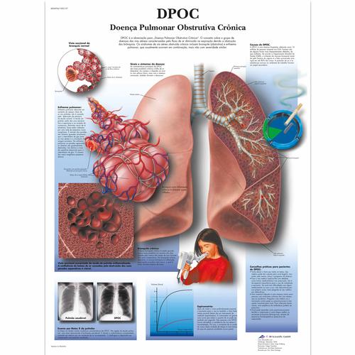 Doen&ccedil;a pulmonar obstrutiva cr&ocirc;nica, 50x67 cm, Laminado, 1002157 [VR5329L], Tobacco Education