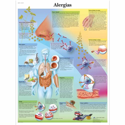 Alergias, 50x67 cm, Versão Papel, 4007011 [VR5660UU], Sistema Imunológico